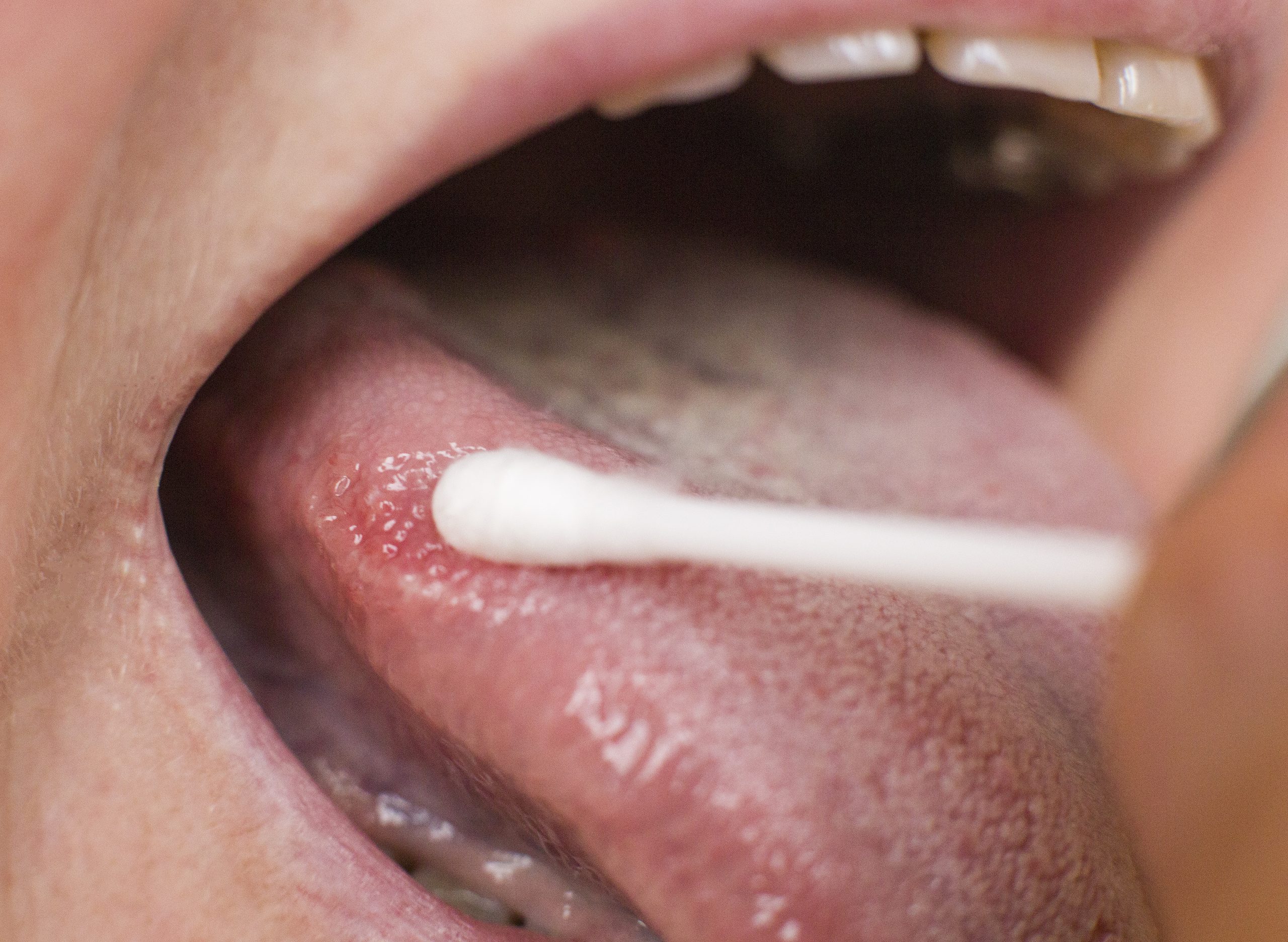 Oral Cancer Risk Factors: Are You at Risk?